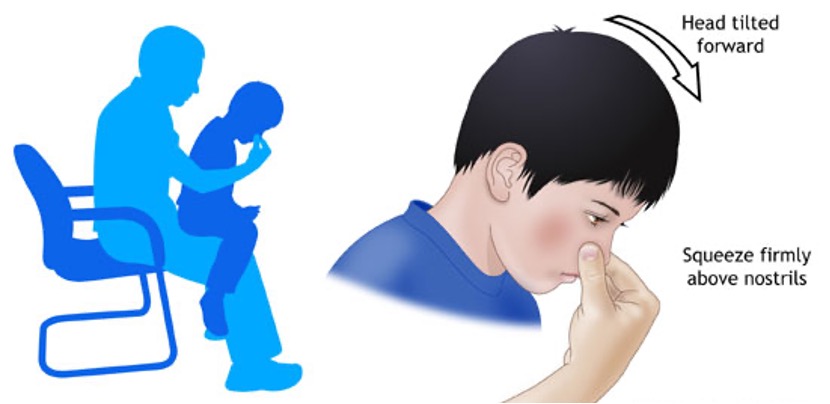 Epistaxis_CPG_Nosebleed first aid